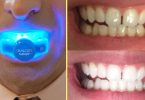 labākie zobu balināšanas komplekti