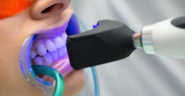 zobu balināšanas procedūra